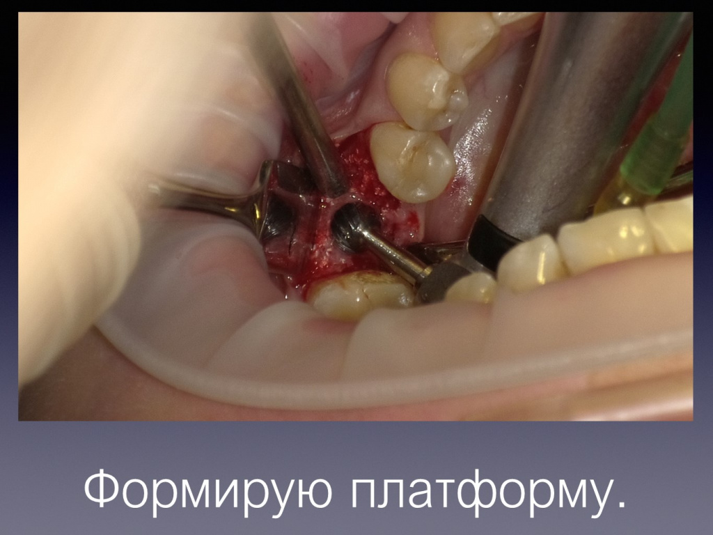 Постановка имплантата после презервации