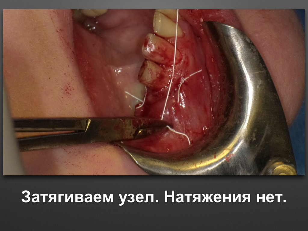 Горизонтальное увеличение альвеолярного отростка