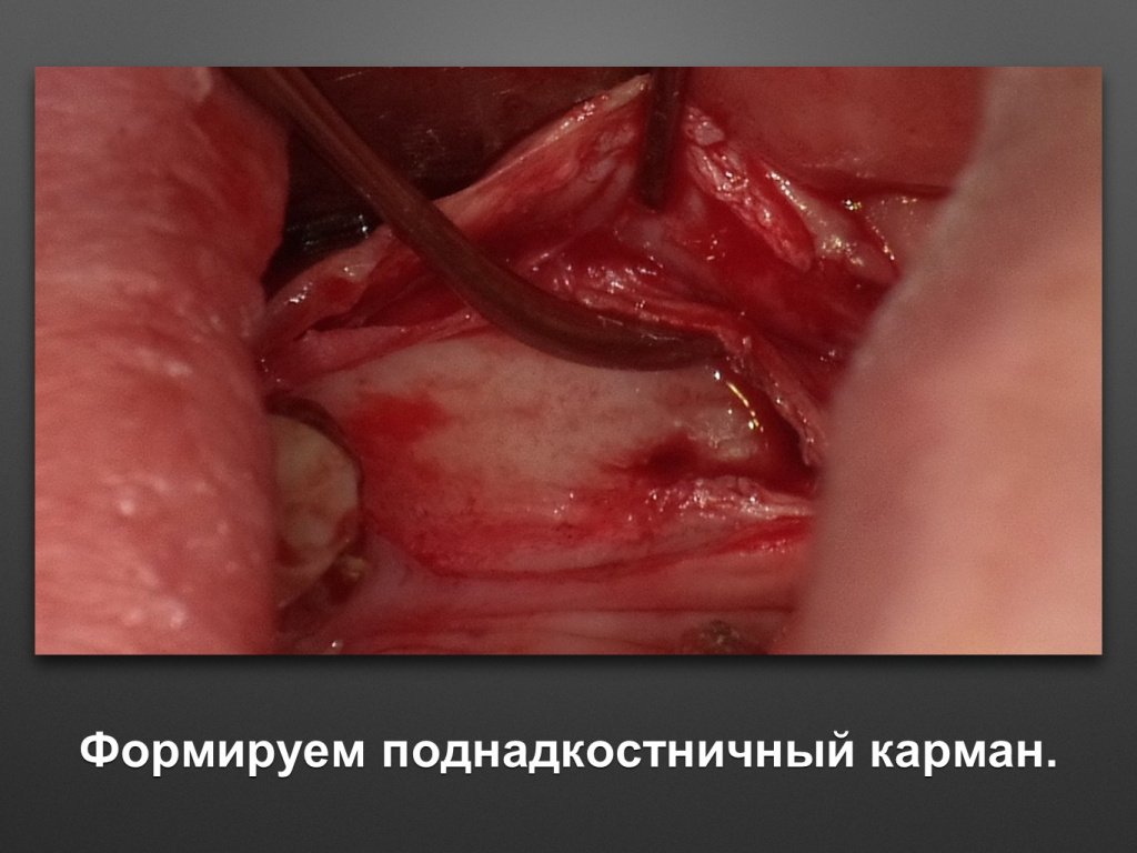 Горизонтальное увеличение альвеолярного отростка