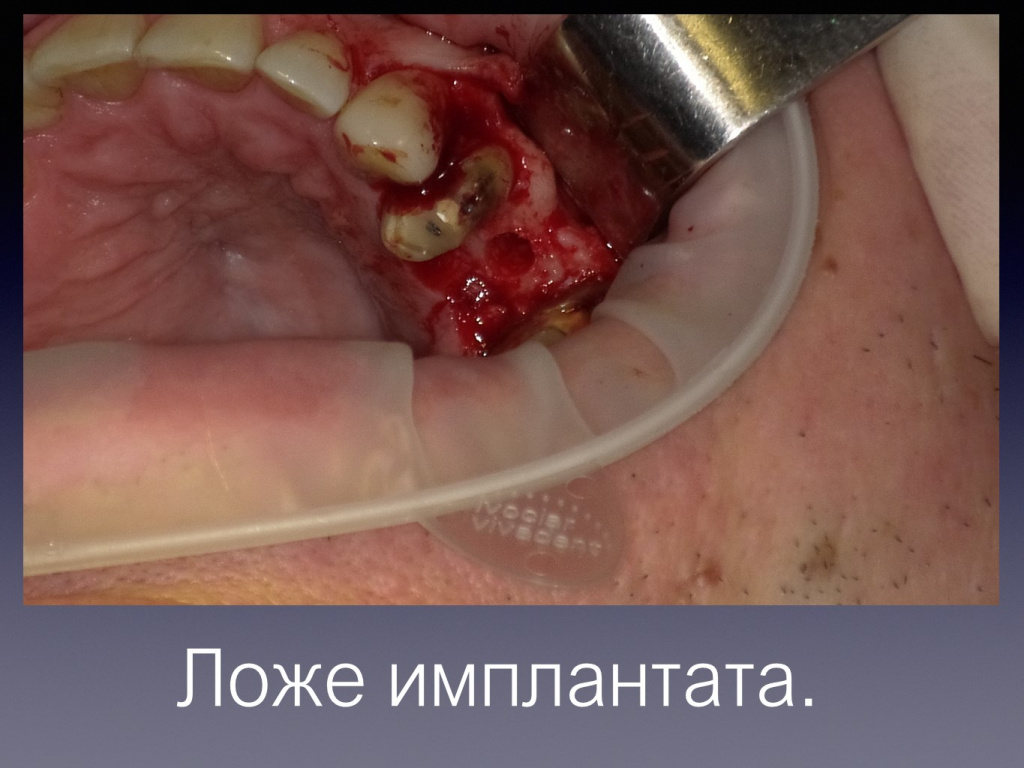 Постановка импланта