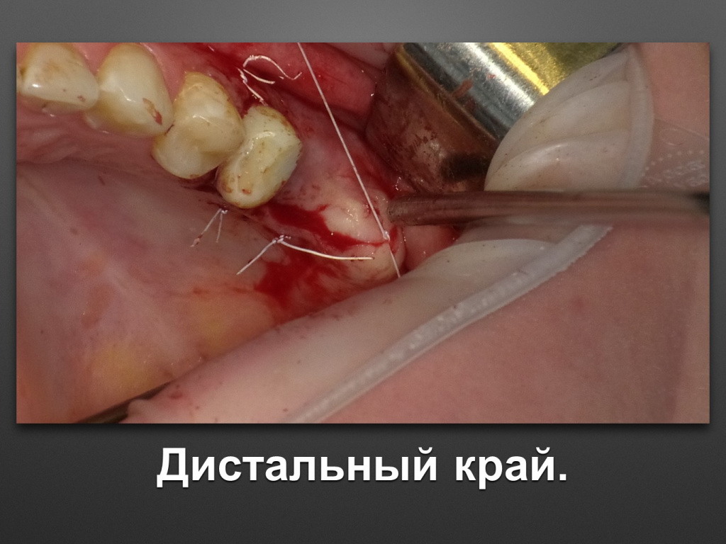 Биоимплант ГАП. Имплантация в дистальном отделе